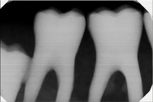 Load image into Gallery viewer, Gendex GXS-700 Dental Digital Intraoral X-Ray Sensor Size 1