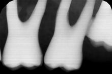 Load image into Gallery viewer, Gendex GXS-700 Dental Digital Intraoral X-Ray Sensor Size 1