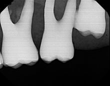 Load image into Gallery viewer, Dexis Platinum PLU 690 Dental Intraoral X-Ray Sensor Size 2 SOLD AS IS