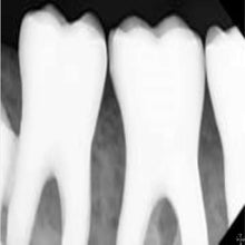 Load image into Gallery viewer, Digital Doc BLU Dental Digital Intraoral X-Ray Sensor Size 1