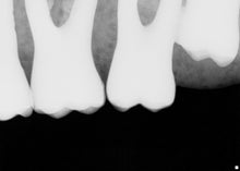 Load image into Gallery viewer, Schick CDR Elite Dental Intraoral X-Ray Sensor Size 2