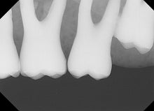 Load image into Gallery viewer, Dentimax Dental Intraoral X-Ray Sensor Size 2