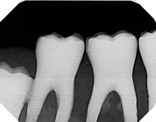 Load image into Gallery viewer, Dexis Platinum Dental Intraoral X-Ray Sensor Size 2 SOLD AS IS