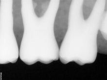 Load image into Gallery viewer, Carestream RVG 6200 Dental Intraoral X-Ray Sensor Size 1