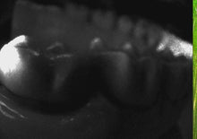 Load image into Gallery viewer, Dexis CariVu Dental Caries Diagnostic Detection Device