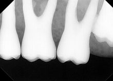 Load image into Gallery viewer, Dentimax Dream Dental Intraoral X-Ray Sensor Size 2