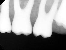 Load image into Gallery viewer, Carestream RVG 6100 Dental Intraoral X-Ray Sensor Size 2