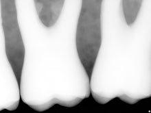 Load image into Gallery viewer, Sirona Schick 33 Dental Intraoral X-Ray Sensor Size 0