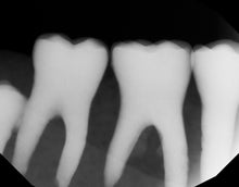 Load image into Gallery viewer, Dexis Titanium Dental Intraoral X-Ray Sensor Size 2