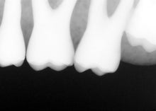 Load image into Gallery viewer, Sirona Schick 33 Dental Intraoral X-Ray Sensor Size 2