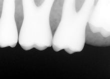 Load image into Gallery viewer, Sirona Schick 33 Dental Intraoral X-Ray Sensor Size 2