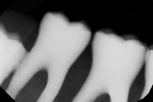 Load image into Gallery viewer, Dexis IXS Dental Intraoral X-Ray Sensor Size 1