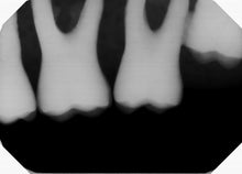 Load image into Gallery viewer, Gendex GXS-700 Dental Intraoral X-Ray Sensor Size 2