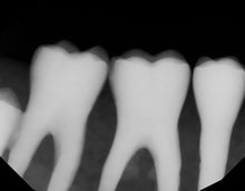 Load image into Gallery viewer, Dexis Titanium Ti2 Dental Intraoral X-Ray Sensor Size 2