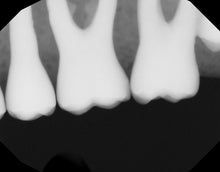 Load image into Gallery viewer, Dexis Titanium Dental Intraoral X-Ray Sensor Size 2