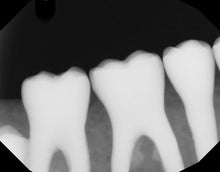 Load image into Gallery viewer, Dexis Titanium Dental Intraoral X-Ray Sensor Size 2