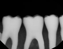 Load image into Gallery viewer, Dexis Titanium Dental Intraoral X-Ray Sensor Size 1.5