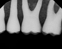 Load image into Gallery viewer, Dexis Titanium Dental Intraoral X-Ray Sensor Size 1.5