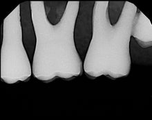 Load image into Gallery viewer, Carina Dental Intraoral X-Ray Sensor Kit Size 1