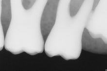 Load image into Gallery viewer, Sirona Schick 33 Dental Intraoral X-Ray Sensor Size 1