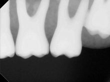 Load image into Gallery viewer, Kodak RVG 6100 Dental Intraoral X-Ray Sensor Size 2