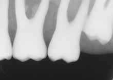 Load image into Gallery viewer, Lot of 2 Sirona Schick 33 Dental Intraoral X-Ray Size 1 Sensor
