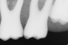 Load image into Gallery viewer, Sirona Schick 33 Dental Intraoral X-Ray Sensor Size 2