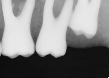 Load image into Gallery viewer, Sirona Schick 33 Dental Intraoral X-Ray Sensor Size 1