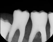 Load image into Gallery viewer, Dexis Platinum Dental Intraoral X-Ray Sensor Size 2