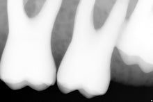 Load image into Gallery viewer, Sirona Schick 33 Dental Intraoral X-Ray Sensor Size 1