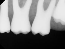 Load image into Gallery viewer, Carestream RVG 6100 Dental Intraoral X-Ray Sensor Size 2