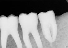 Load image into Gallery viewer, Schick CDR Elite Dental Intraoral X-Ray Sensor Size 2