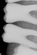 Load image into Gallery viewer, Sirona Schick CDR Elite Dental Digital X-Ray Sensor Size 1
