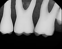 Load image into Gallery viewer, Dexis Platinum Digital Dental X-Ray Sensor Size 2 PerfectSize Direct USB 64bit