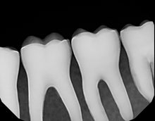 Load image into Gallery viewer, Dexis Platinum Digital Dental X-Ray Sensor Size 2 PerfectSize Direct USB 64bit