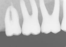 Load image into Gallery viewer, Sirona Schick 33 Dental Intraoral X-Ray Sensor Size 2