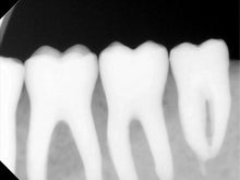 Load image into Gallery viewer, Carestream RVG 6100 Dental Intraoral X-Ray Sensor Size 1 SOLD AS IS
