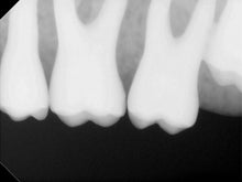 Load image into Gallery viewer, Carestream Kodak RVG 6100 Size 2 Digital Intraoral X-Ray Sensor Dental Imaging