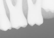 Load image into Gallery viewer, Sirona Xios XG Supreme Dental Intraoral X-Ray Sensor Size 1