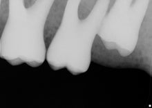 Load image into Gallery viewer, Sirona Schick CDR Elite Size 2 Digital Intraoral X-Ray Dental Sensor