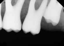 Load image into Gallery viewer, XDR Digital Dental X-Ray Sensor Size 2 Intraoral Radiography CMOS Imaging
