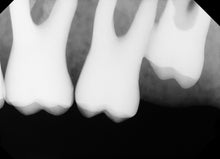 Load image into Gallery viewer, XDR Digital Dental X-Ray Sensor Size 2 Intraoral Radiography CMOS Imaging