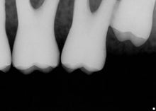 Load image into Gallery viewer, Schick CDR Elite Size 2 Digital Dental Intraoral X-Ray Sensor Kit