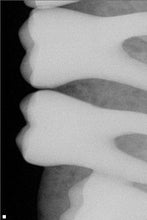 Load image into Gallery viewer, Schick CDR Elite Size 1 Digital Dental Intraoral X-Ray Sensor