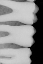 Load image into Gallery viewer, Schick CDR Elite Size 1 Digital Dental Intraoral X-Ray Sensor