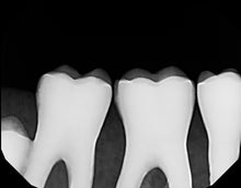 Load image into Gallery viewer, Dexis Platinum Intraoral Digital X-Ray Dental Sensor Size 2