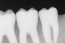 Load image into Gallery viewer, Sirona Schick 33 Dental X-Ray Digital Sensor Size 1