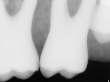 Load image into Gallery viewer, Sirona Schick 33 Dental X-Ray Digital Sensor Size 0