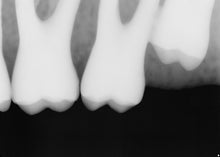 Load image into Gallery viewer, Sirona Schick 33 Digital Dental X-Ray Sensor Size 2
