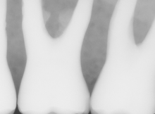 Load image into Gallery viewer, Sirona Schick 33 Dental Intraoral X-Ray Sensor Size 0